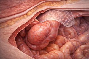 hernia_internal_hd_under_1mb